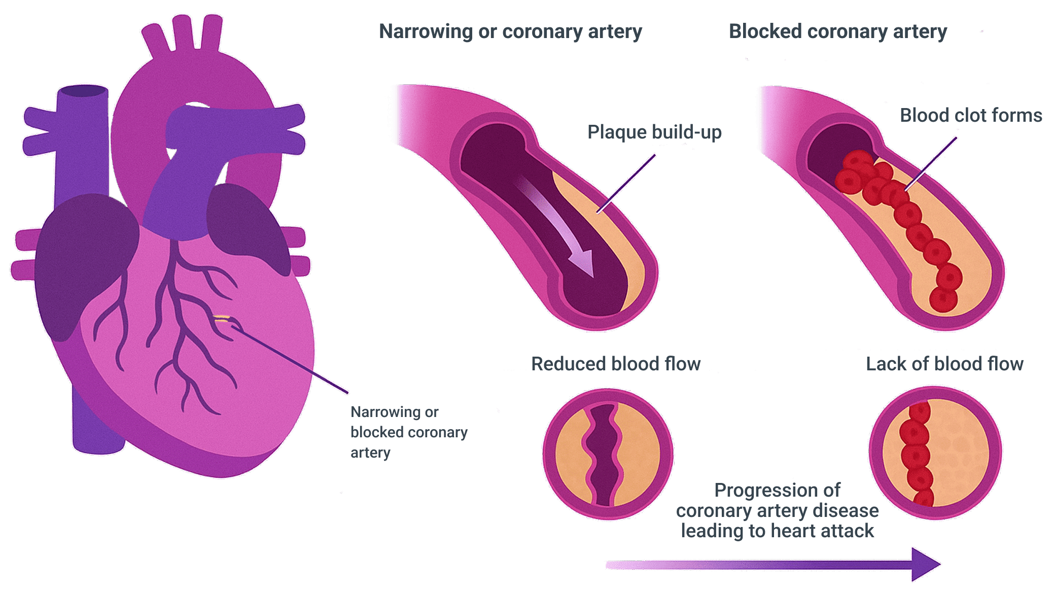 coronary artery disease leads to Myocardial ischemia graphic