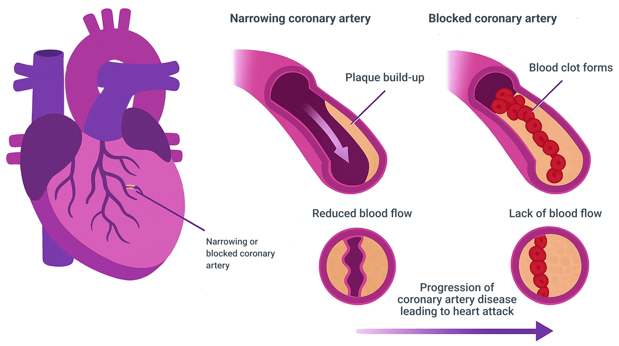 coronary artery disease leads to Myocardial ischemia graphic
