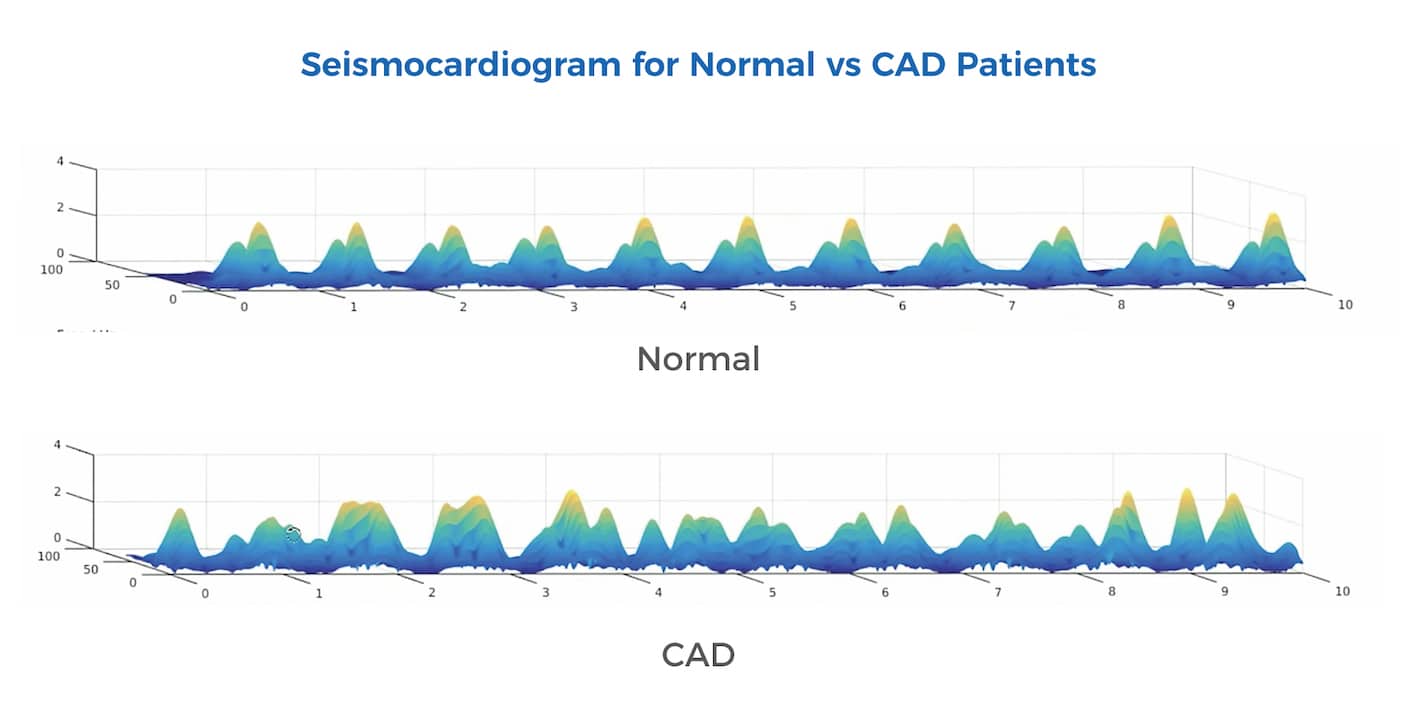 Seismocardiogram for Normal Versus CAD Patients