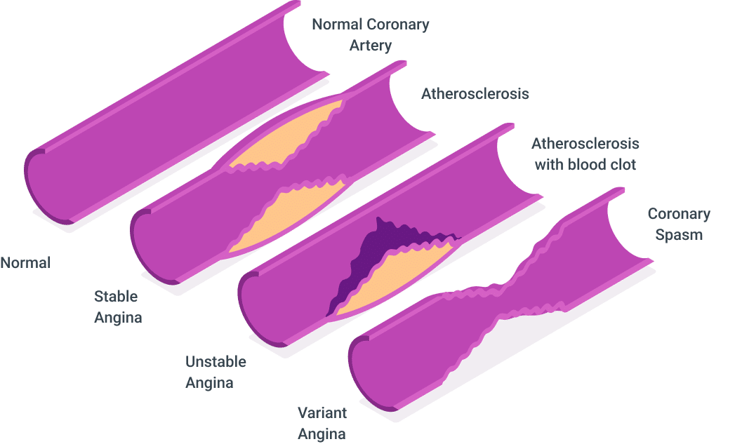 Types of Angina ICD-10 code 125.1 Illustration