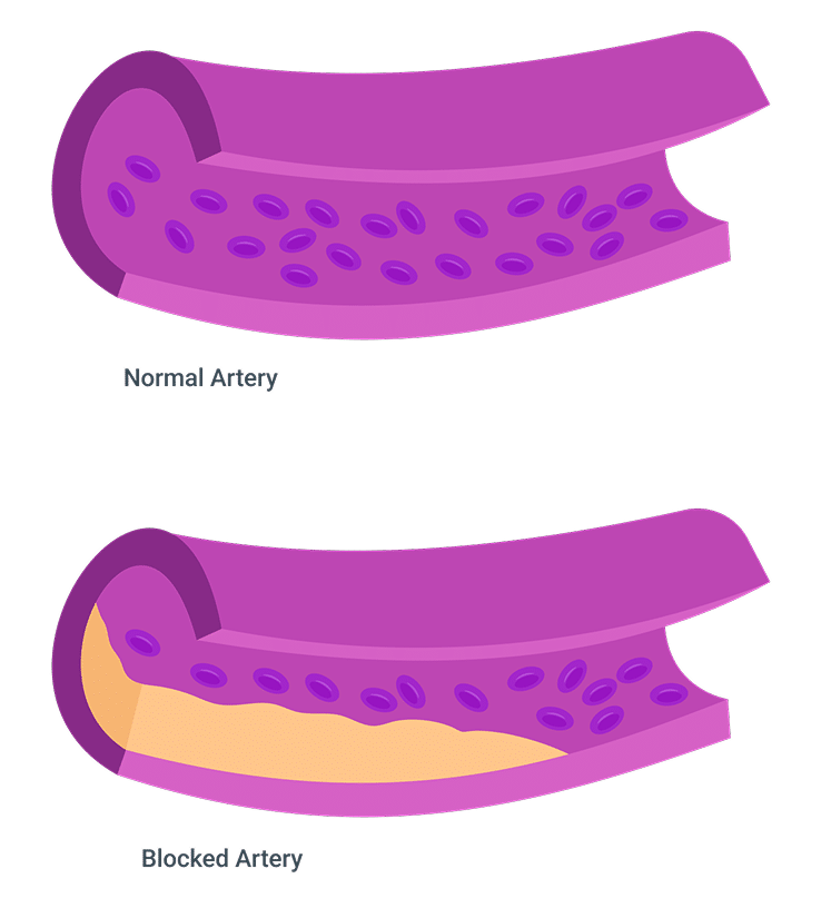 Comparison of normal and blocked artery