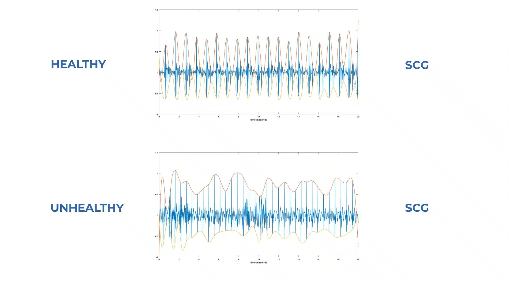 Healthy vs unhealthy heart rhythm (SCG) graph